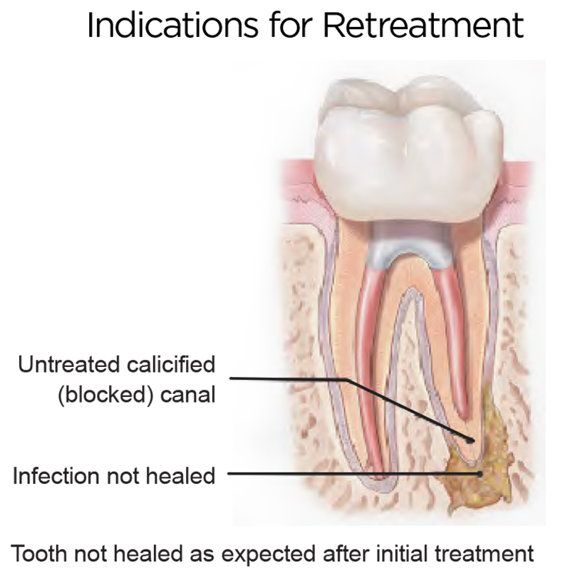 Indications for retreatment