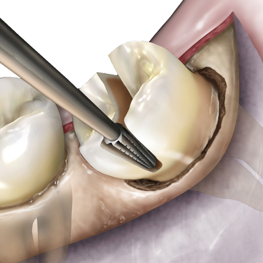 Oral Surgery Illustration